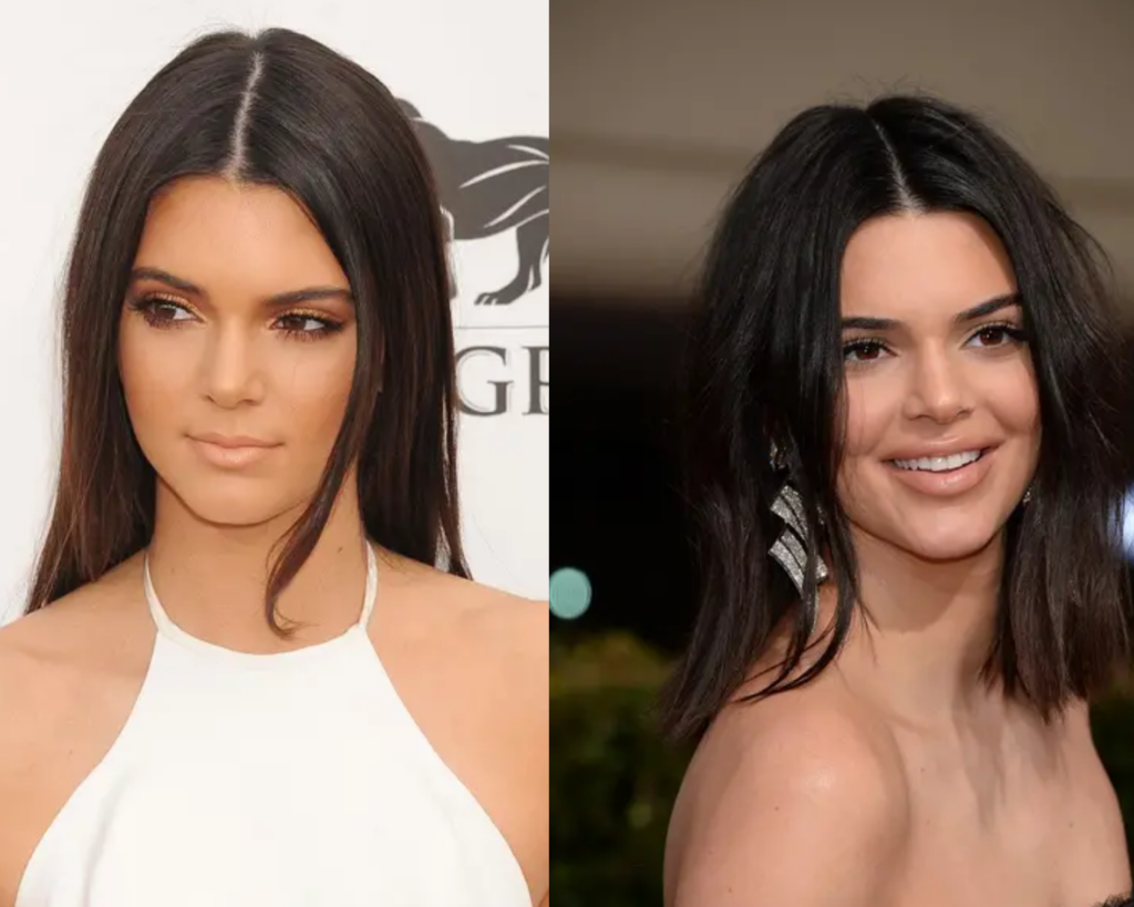 Kendall-Jenner-chirurgie-esthétique