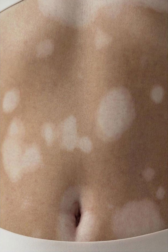 vitiligo beauty photography elisabeth van aalderen 10 5dd3a13aabfcb 700 vitiligo