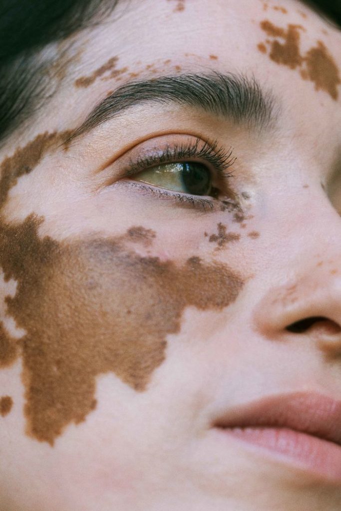 vitiligo beauty photography elisabeth van aalderen 7 5dd3a02415458 700 vitiligo