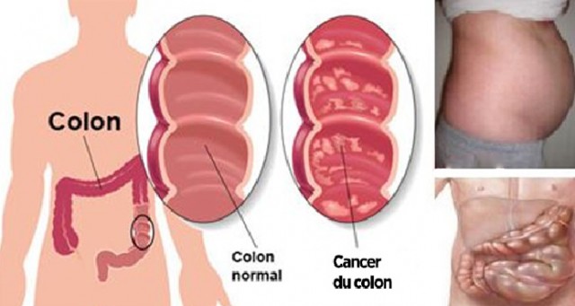 10 signes precurseurs dun cancer du colon 640x341 1 côlon traitement