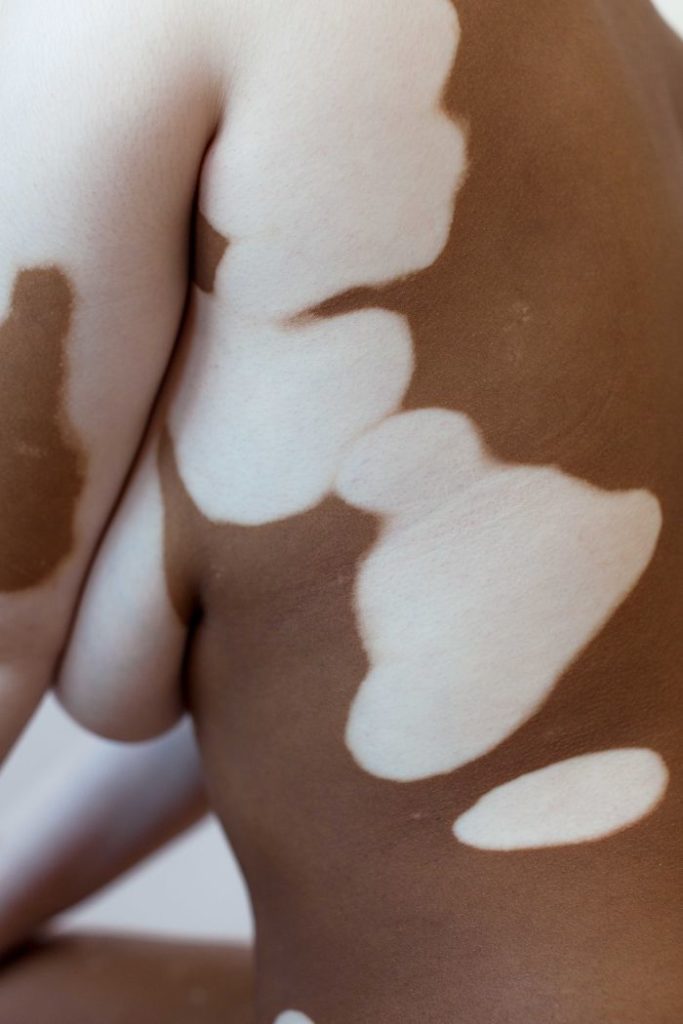 Deborah Elisabeth van Aalderen vitiligo 3 5dd3a0042f809 700 vitiligo