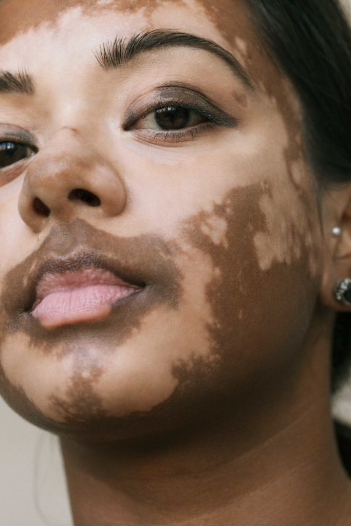vitiligo beauty photography elisabeth van aalderen 1 5dd3a009ace8e 700 vitiligo