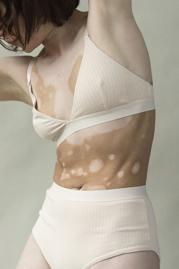 vitiligo beauty photography elisabeth van aalderen 19 5dd3a04d72a8b 700 vitiligo