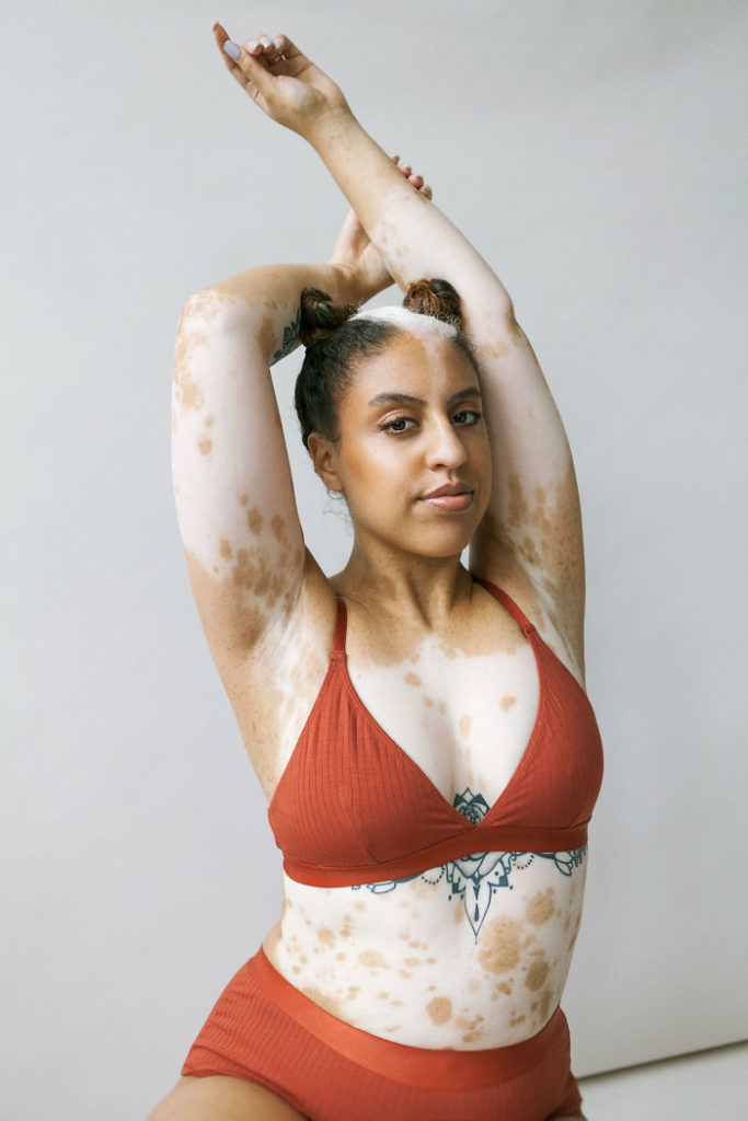 vitiligo beauty photography elisabeth van aalderen 22 5dd3a056d337a 700 vitiligo