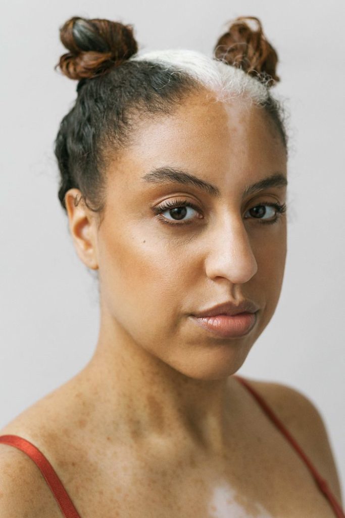 vitiligo beauty photography elisabeth van aalderen 24 5dd3a06033781 700 vitiligo