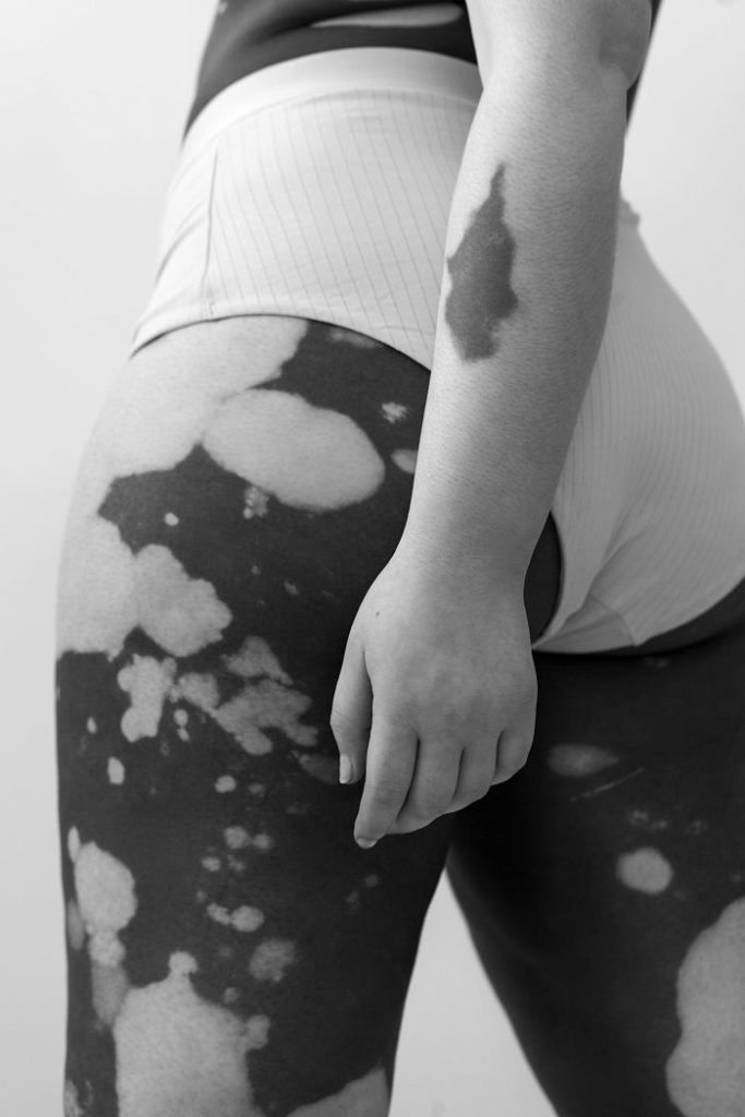 vitiligo beauty photography elisabeth van aalderen 26 5dd3a064bf7ca 700 vitiligo