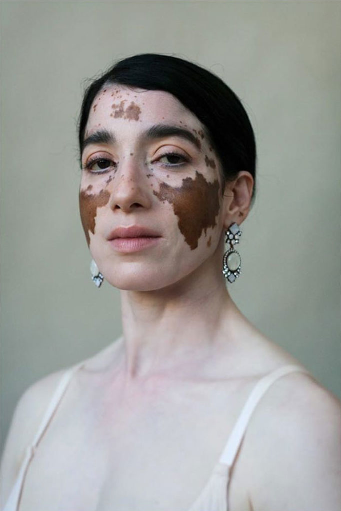 vitiligo beauty photography elisabeth van aalderen 3 5dd3a1384c216 700 vitiligo
