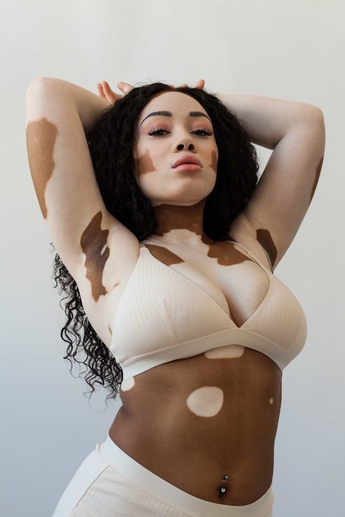 vitiligo beauty photography elisabeth van aalderen 31 5dd39ffe8f328 700 vitiligo