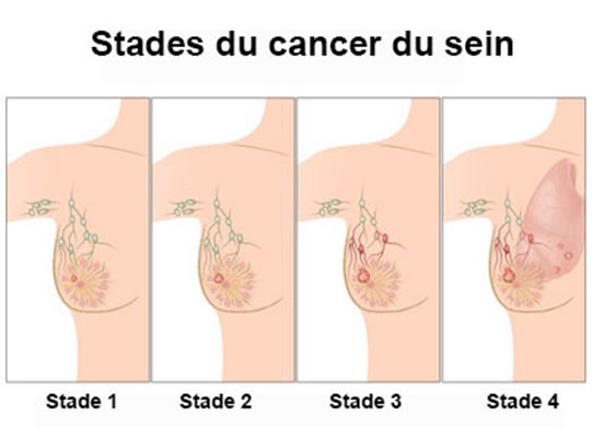 stades cancer cancer du sein